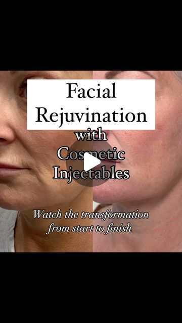 Nurse Kelly Botox & Filler cosmetic transformations | 𝐁𝐞𝐟𝐨𝐫𝐞 & 𝐀𝐟𝐭𝐞𝐫 𝐓𝐫𝐚𝐧𝐬𝐟𝐨𝐫𝐦𝐚𝐭𝐢𝐨𝐧

Watch along as we fulfill our goals of a  natural rejuvination for our lovely patient using @juvedermcanada... | Instagram Cheek Filler Before And After, Botox And Fillers Before After, Contour Jowls, Facial Fillers Before And After, Botox Jawline Before And After, Jawline Fillers Before And After, Chin Fillers Before After, Botox Before After, Cheek Injections