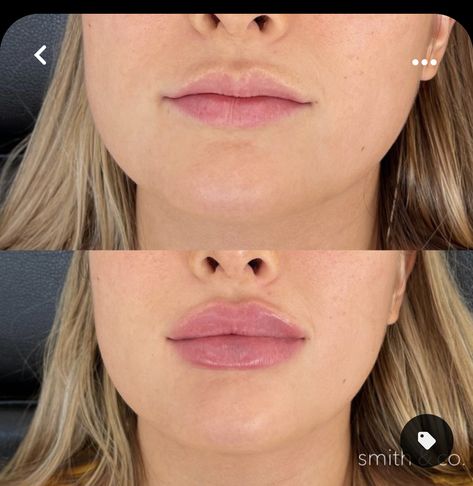 Allergan Botox, Dermal Fillers Lips, Fuller Lips Naturally, Aesthetic Medical, Face Treatments, Lips Inspiration, Face Fillers, Botox Lips, Facial Fillers