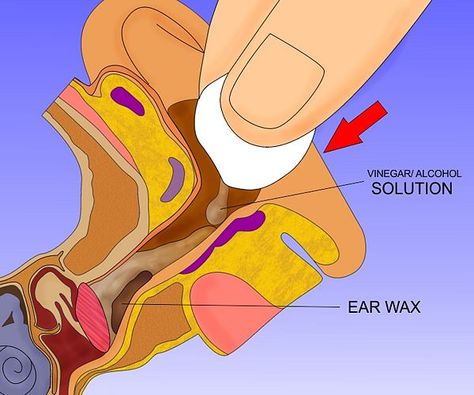 Get Rid of Ear Wax - wikiHow Clean Ear Wax Out, Swimmers Ear Remedy, Impacted Ear Wax, Ear Wax Candle, Ear Cleaning Wax, Clogged Ears, Ear Wax Buildup, Swimmers Ear, Ear Pressure