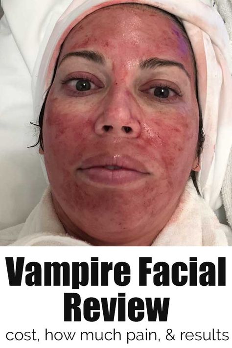 Vampire Facial Review: PRP Facial | The Happier Homemaker Prp Before And After, Prp Microneedling Before And After, Vampire Facial Before And After, Prp Face Before And After, Vampire Facial Benefits, Facial Protocol, Benefits Of Regular Facials, Prp Facial, Ultrasonic Facial Benefits