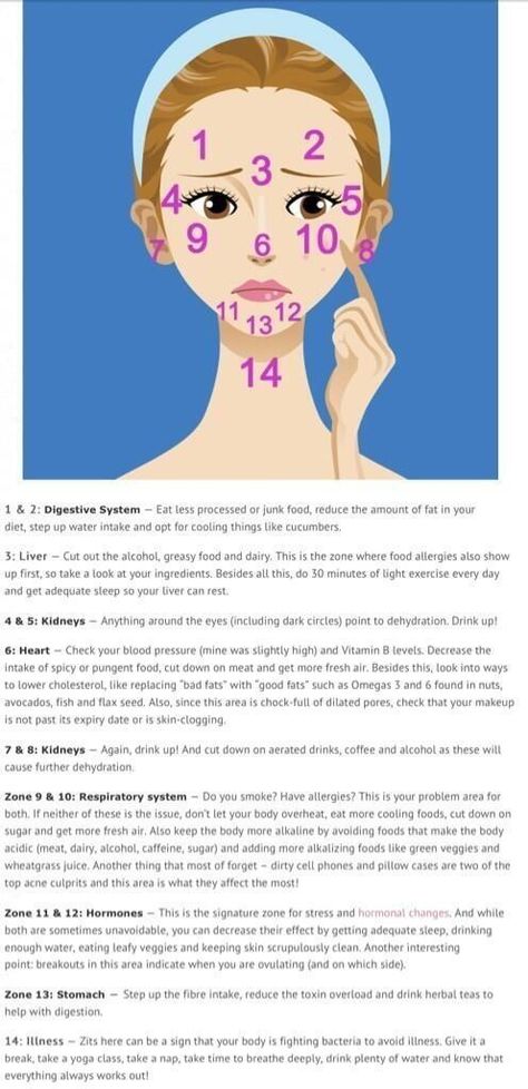 acne's location on the face, and what it means. Doterra Acne, Gesicht Mapping, Face Mapping Acne, Face Mapping, Light Exercise, Acne Causes, Acne Problem, Face Acne, Acne Remedies