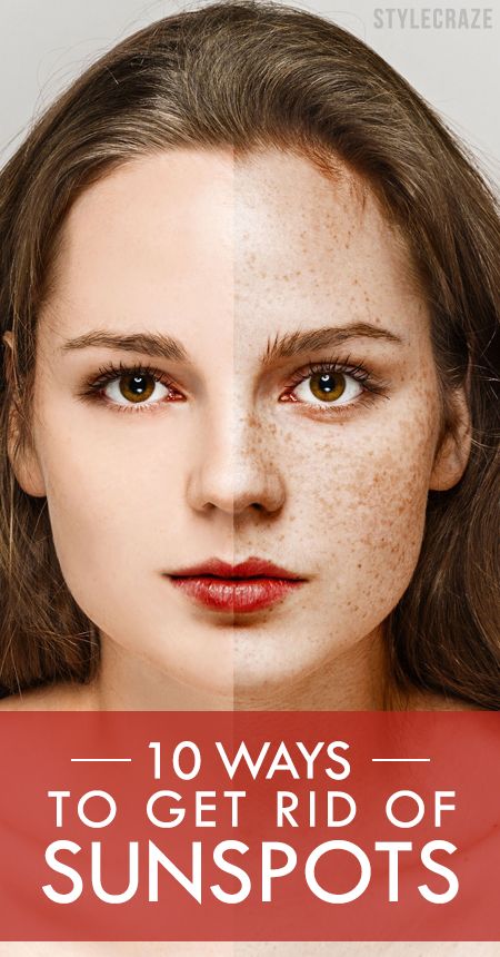 Are sunspots one reason you hate summers? Don’t worry, as there are a number of ways you can treat sunspots and enjoy summers to the fullest!  #skincare Sun Spots On Skin, Black Spots On Face, Sunspots On Face, Brown Spots On Hands, Brown Age Spots, Brown Spots On Skin, Brown Spots Removal, Brown Spots On Face, Skin Spots