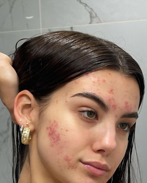 Girl With Acne, Best Dark Spot Corrector, Facial Skin Care Routine, Bare Beauty, Love Your Skin, Pretty Skin, My Beauty, Acne Skin, Flawless Skin