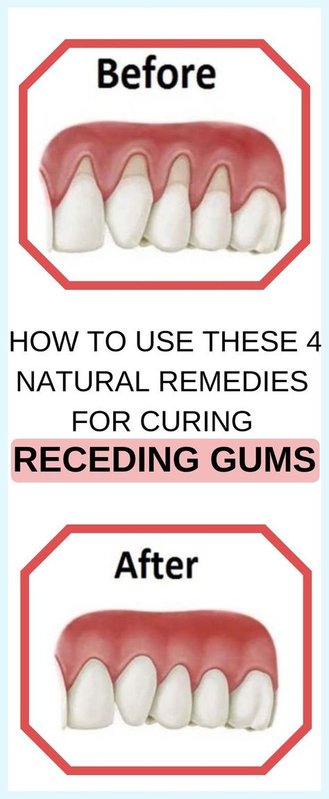 7 Natural Ways To Treat Receding Gums Teeth Health, Green Food, Oral Care Routine, Receding Gums, Gum Care, Oral Health Care, Tooth Decay, Healthy Teeth, Natural Home Remedies