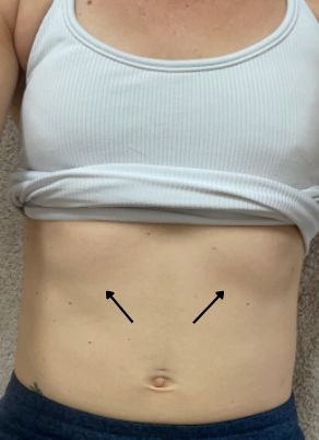 What is a rib flare and how to correct it? — Erica Friedman Wellness Correct Rib Flare, Rib Cage Flare, How To Get Rid Of Rib Fat Work Outs, Rib Flare Correction, Shrink Rib Cage, How To Shrink Rib Cage, Wide Ribcage Workout, How To Fix Rib Flare, Rib Flare Correction Exercises