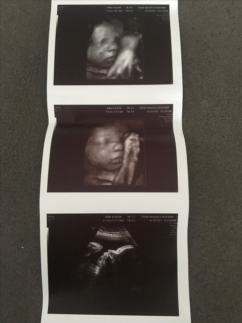 5 Months Pregnant Ultrasound, 8weeks Pregnant Ultrasound, 5 Weeks Pregnant Ultrasound, 6 Weeks Pregnant Ultrasound, 16 Weeks Pregnant Ultrasound, 4d Ultrasound, Ultrasound Technician, Baby Ultrasound, Ultrasound Tech