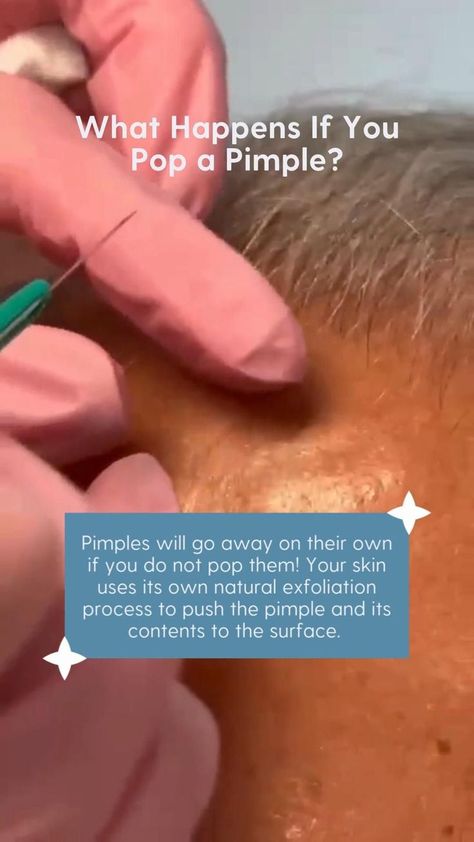 Painful Pimple, Blind Pimple, Acne Help, Acne Skincare Routine, How To Get Rid Of Pimples, Acne Solutions, Natural Exfoliant, Acne Care, Acne Skin