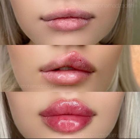 Doll Lips Filler, 1 Ml Lip Filler, Lip Plastic Surgery, Plastic Surgery Fails, 1ml Lip Filler, Dermal Fillers Lips, Extreme Plastic Surgery, Juvederm Lips, Lips Fillers