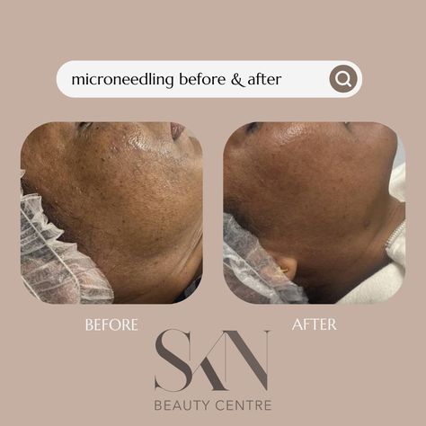 🌟 Witness the Miraculous Before and After Results of Microneedling! 🌟 From reducing fine lines and wrinkles to fading acne scars and hyperpigmentation, microneedling works wonders in revitalizing the skin and revealing a smoother, more youthful complexion. ⏳ Long-lasting Results: These stunning before and after photos are a testament to the long-lasting benefits of microneedling. With each session, your skin continues to improve, leaving you with a revitalized complexion that radiates confi... Benefits Of Microneedling, Fire And Ice Facial, Oxygen Facial, Flaking Skin, Beauty Clinic, Cosmetic Procedures, Collagen Production, Wound Healing, After Photos