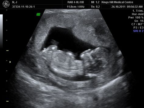 Today we went to see Mr Penman for our 12 week Nuchal Scan and screening. His clinic advises that the best time for this test is at 12.5 weeks. We went today as I thought I was 12 weeks and 4 days.... 12 Weeks Pregnant Ultrasound, Ob Ultrasound, Gyn Ultrasound, 12 Week Ultrasound, 12 Week Scan, Ultrasound School, Obstetric Ultrasound, Arte Ganesha, Molar Pregnancy