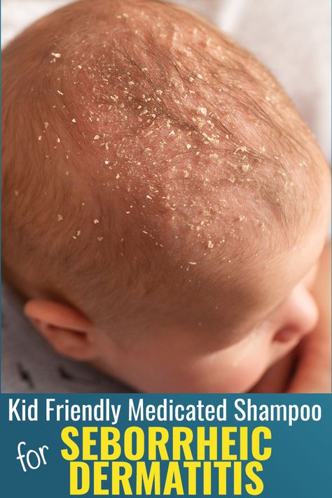 Many people see the picture of this infant and think dandruff, but this is actually called seborrheic dermatitis.  Dr. Eddie’s Happy Cappy shampoo and body wash is a kid friendly medicated shampoo and body wash for relief of skin and scalp itching, irritation, redness, flaking, and scaling associated with seborrheic dermatitis. #SeborrheicDermatitis Happy Cappy, Cradle Cap, Dandruff Shampoo, Beard Growth, Dry Scalp, Acid Reflux, Beard Oil, Sulfate Free, Dandruff