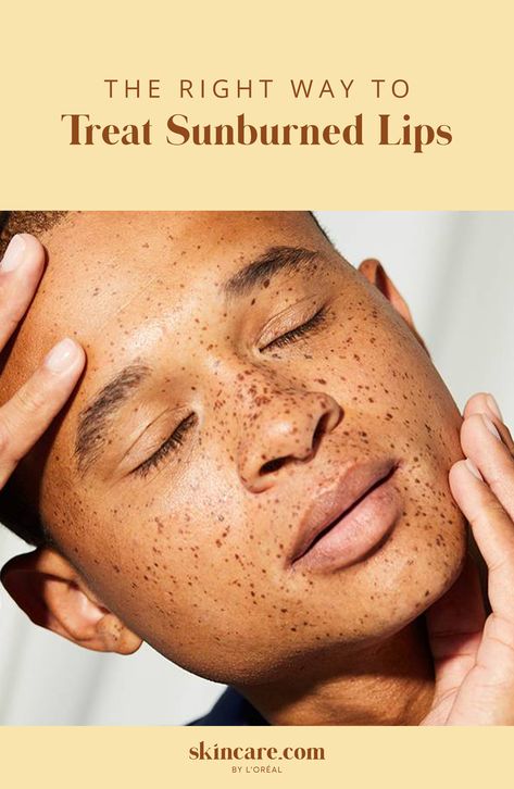 How to Treat Sunburned Lips Sun Blisters, Blister On Lip, Sunburned Lips, Severe Sunburn, Sun Allergy, Skin Marks, Spf Lip Balm, Lip Beauty, Healthy Advice