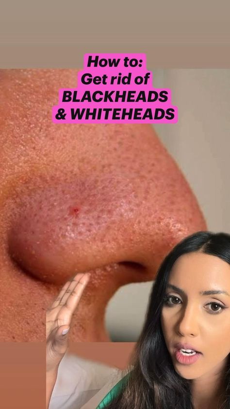 #getridofblackheadsonnose Blackheads And Whiteheads, Bentuk Alis, Rid Of Blackheads, Serious Skin Care, Good Skin Tips, Skin Care Tutorial, Basic Skin Care Routine, Clear Skin Tips, Glo Up