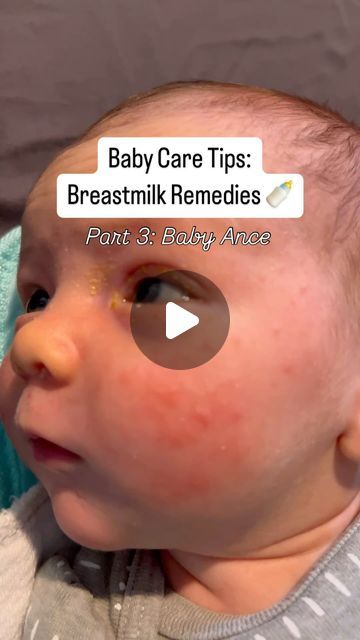 Helen on Instagram: "Details! ✨👇

Baby acne may catch new parents off guard, but here’s the magical part—those tiny bumps can heal on their own, and fast! ✨ while baby acne is not painful, it is understandable to want to heal it as fast as possible! 

Breastmilk, nature’s ultimate remedy, can speed up the healing process. 💧 Rich in antibodies and nutrients, dabbing a bit of breastmilk on the acne helps reduce redness and calm irritation—soothing that delicate skin in the gentlest way possible. It’s like a magical potion you already have, working wonders while being completely safe for your little one. 🍼

As your baby grows, their skin will keep showing off its incredible ability to regenerate. 🙌 Whether it’s acne, rashes, or little skin bumps, their body is hard at work, healing in rec Milk Allergy Baby, Baby Acne Remedy, Newborn Acne, Rash On Face, Magical Potion, Baby Acne, Skin Bumps, Acne Help, Baby Facts