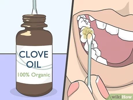 4 Ways to Use Clove Oil for Tooth Pain - wikiHow Clove Oil Benefits Teeth, Home Remedy For Tooth Infection, Essential Oils For Tooth Infection, Cloves For Tooth Pain, Natural Tooth Pain Relief, How To Make Clove Oil, Clove Oil For Tooth Ache, Toothache Remedies Instant, Essential Oils For Tooth Pain