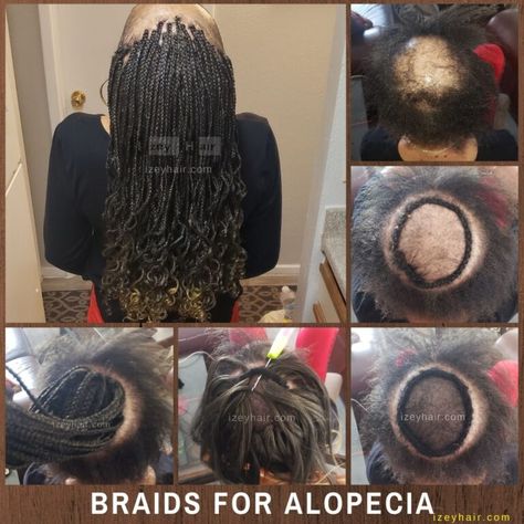 Braids for Alopecia Crochet Braids For Alopecia, Braids For Alopecia For Black Women, Alopecia Braid Styles, Braids For Alopecia, Cornrows Protective Styles, Individual Box Braids, Dread Ideas, Cornrows Updo, Twists Cornrows