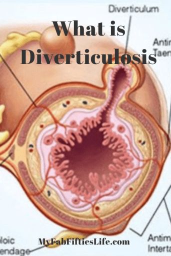 My Fab Fifties Life - What is Diverticulosis - My Fab Fifties Life Diverticulos Symptoms, Diviticulitis Diet, Retired Life, Lung Detox, Low Fiber Diet, Clogged Arteries, Wellness Clinic, Fiber Diet, Life Blogs