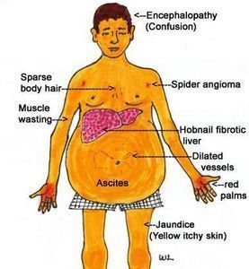 Cirrhosis School Necessities, Nursing Information, Nursing Board, Med Surg Nursing, Nursing Mnemonics, Surgical Nursing, Medical Surgical Nursing, Nursing School Survival, Nurse Rock