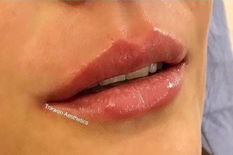 Lip Fillers Cupids Bow, Cupid Bow Lips Filler, Defined Cupids Bow Lips, Bow Shaped Lips, Cupid Bow Lips, Bow Lips, Cupids Bow Lips, Medical Aesthetician, Lips Inspiration