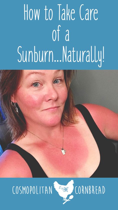 Essential Oil For Sunburn Relief, What To Put On Sunburn Skin, Remedies For Sunburn Skin, Homemade Sunburn Relief, Bath For Sunburn Relief, What Helps With Sunburns, Remedies For Sunburn Face, After Sunburn Care, Tips For Sunburn