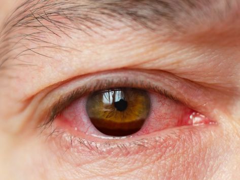 Hyphema (Bleeding in Eye): Diagnosis, Symptoms & Causes Chronic Dry Eye, Dry Eyes Causes, Dry Eye Symptoms, Eye Diseases, Eye Problems, Eye Infections, Dry Eye, Watery Eyes, Nasal Spray