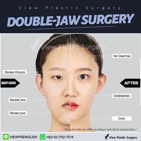 Bigger Eyes Surgery, Protruding Chin, Chin Surgery, Square Jaw, Double Jaw Surgery, Face Slimmer, Bigger Eyes, Face Surgery, Facial Bones