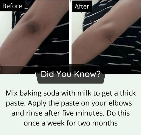 Dark elbow remedy Dark Knees And Elbows, Dark Knees, Facial Tips, Really Good Comebacks, Natural Skin Care Remedies, Natural Face Skin Care, Good Skin Tips, Basic Skin Care Routine, Healthy Advice