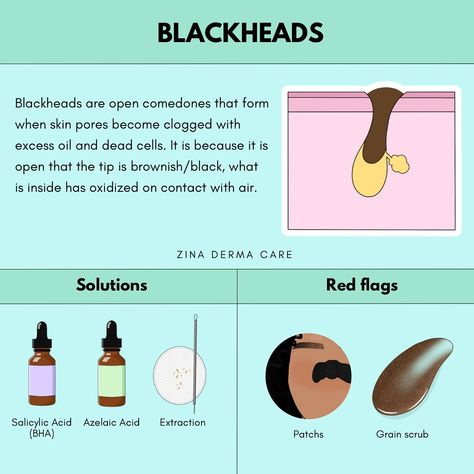 🖤 BLACKHEADS 101🖤 Did you know that blackheads are open comedones that occur when your skin pores get clogged with excess oil and dead skin cells? The reason for their characteristic brownish/black tip is that the contents oxidize upon contact with air! ✨ Solutions to Say Goodbye to Blackheads Salicylic Acid: A powerful BHA that penetrates pores to clear out debris. Azelaic Acid: Helps to exfoliate and reduce inflammation. Extraction: Professional removal for a fresh start! 🚫 Red Flags to... Salicylic Acid Benefits, Clear Skin Routine, Azelaic Acid, Get Rid Of Blackheads, Skin Pores, Red Flags, To Say Goodbye, A Fresh Start, Glycolic Acid