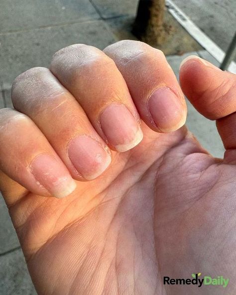 Home Remedies Brittle Nails, Strong Nails, Natural Beauty Tips, About Hair, Spring Nails, Home Remedies, Beauty Health, You Can Do, Body Care