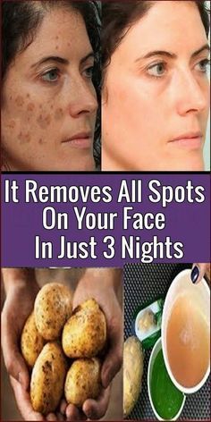 Spots On Forehead, Brown Age Spots, Brown Spots On Skin, Creme Anti Age, Brown Spots Removal, Brown Spots On Face, Skin Spots, Spots On Face, Baking Soda Shampoo