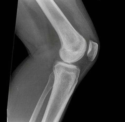 x-ray of left knee. Anatomy Of The Knee, Human Body Unit, Cruciate Ligament, Dramatic Play Preschool, Dramatic Play Centers, Classical Conversations, Kindergarten Science, Preschool Science, Insulin Resistance