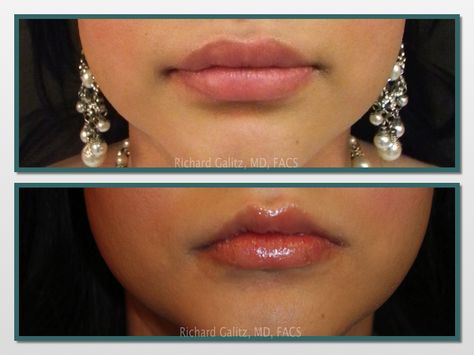 Lip reduction.  This patient had too much silicone in both lips.  With a lip reduction I was able to achieve the Cupid's Bow shaped lip she desired. Richard Galitz, MD, FACS - Miami - Cupid Lips Filler, Lip Reduction, Bow Lips, Cupids Bow Lips, Cupid Bow, Lips Inspiration, Cupid's Bow, Lip Augmentation, Cupids Bow