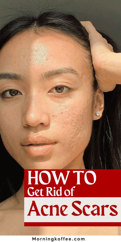 Acne Scar Remedies, Scar Remedies, Acne Scaring, Face Mapping Acne, Acne Prone Skin Care, Acne Overnight, Get Rid Of Acne, Rid Of Acne, Natural Acne Remedies