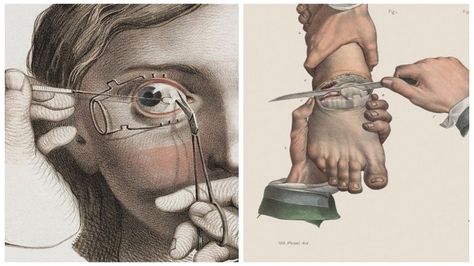 Morbidly Beautiful Illustrations Reveal The Horror Of Surgery In The 15th–19th Centuries Humphry Davy, Surgery Art, Surgical Procedures, Eminem Photos, Human Anatomy Art, Medical Anatomy, Vintage Medical, Medical Aesthetic, Inventors