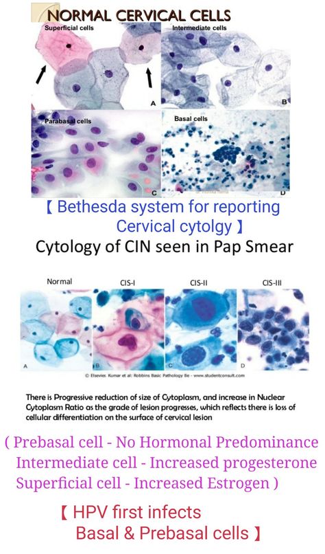 Cervical cytology - Normal & Abnormal 【 Note : Increase Nucleus cytoplasmic ratio & loss of differentiation in CIN 】#cervix Cytology Notes, Histology Slides, Medical Laboratory Scientist, Basal Cell, Medicine Notes, Tissue Types, Squamous Cell, Cell Biology, Medical Studies