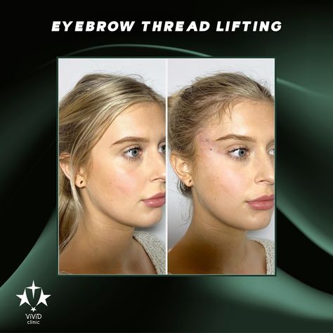 ✨ Lift and define your brows with Eyebrow Thread Lifting at Vivid Clinic! This non-surgical procedure uses fine threads to gently lift and reshape your brows, giving you a youthful, lifted appearance with minimal downtime. 💫 ✅ Non-surgical brow lift for a more defined look ✅ Instant, natural results with minimal recovery ✅ Perfect for creating a more youthful, refreshed appearance 💬 Ready for a brow transformation? Book your free consultation today with Vivid Clinic and achieve the perfect ... Lifted Brows, Brow Transformation, Eyebrow Lift, Thread Lift, Threading Eyebrows, Brow Lift, Free Consultation, Eyebrows, Thread