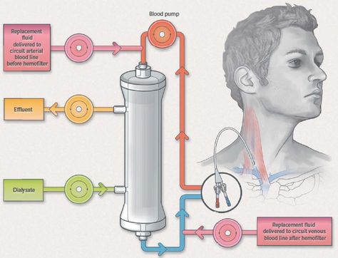 Continuous renal replacement therapy (CRRT) Renal Replacement Therapy, Nephrology Nursing, Renal Nursing, Nursing Necessities, Renal Physiology, Medical Reference, Nurse Tips, Medical Nursing, Pharmacy Medicine
