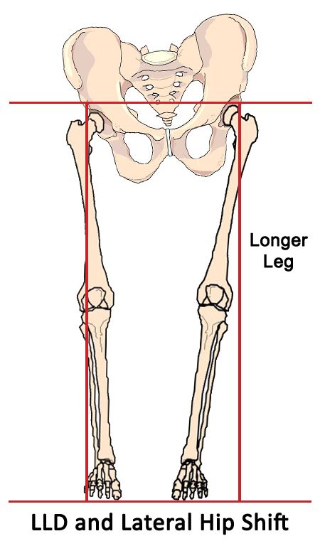 Leg Length Discrepancy, Psoas Release, Inner Knee Pain, Psoas Muscle, Nerve Pain Relief, Sciatic Nerve Pain, Knee Pain Relief, Sciatica Pain, Sciatic Nerve