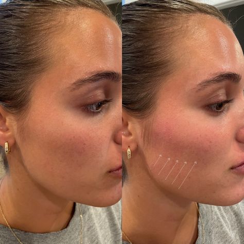 𝑨 𝒍𝒐𝒐𝒌 𝒀𝑶𝑼'𝑳𝑳 𝑳𝑶𝑽𝑬! Loss of check definition, or CONTOUR, can make you look tired or drained. NOT ANYMORE - release your inner radiance with @Restylaneusa CONTOUR. Filler For Cheek Enhancement ✨ Flexible Movement ✨ Natural-looking results ✨ Long Lasting Cheek Fillers Round Face, Natural Fillers For Face, Mid Cheek Filler, Cheek Filler Before And After, Cheeks Filler, Face Contouring Fillers, Cheek Fillers Before And After Face, Chin Filler, Dream Face