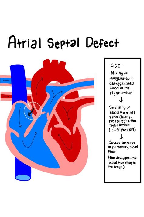 Atrial Septal Defect: mixing of oxygenated and deoxygenated blood in the right atrium. Shunting of blood from left atria (higher pressure) to the right atria (lower pressure). Causes increase in pulmonary blood flow (the deoxygenated blood traveling to the lungs) Atrial Septal Defect Nursing, Pediatric Heart Defects Nursing, Peds Cardiac Nursing, Hemodynamics Nursing, Nursing School Cardiac, Pediatric Sonography, Cardiac Pathology, Cardiac Notes, Clinical Anatomy