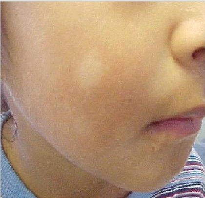 What Are Those White Spots on My Child's Face? Skin Bumps On Face, White Skin Patches, White Skin Spots, Skin Bumps, Dry Skin On Face, Vitamin Deficiency, Dry Skin Remedies, Tongue Health, Brown Spots On Face