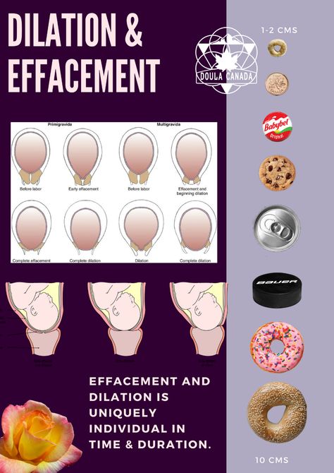 Cervical Dilation & Effacement (Hand Out) - Doula Training Canada Cervical Effacement, Dilation And Effacement, Doula Resources, Cervical Dilation, Doula Training, Birth Doula, Birth Labor, Anatomy And Physiology, Labour