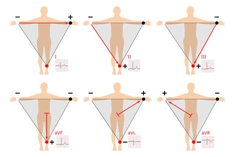 12 Lead Ekg Placement, Ecg Placement, Ekg Placement, Ekg Leads, Ekg Rhythms, Cardiac Sonography, Ekg Interpretation, Ecg Interpretation, Paramedic School