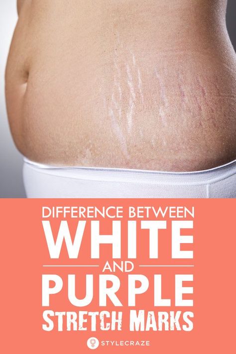 Do You The Know The Difference Between White Stretch Marks And Purple Stretch Marks: Stretch marks are usually red when the skin has just started stretching. Which means that if action is taken, the skin can go back to its former state and silvery, permanent stretch marks can be avoided. keep reading to know how to get rid of stretch marks! #skin #skincare #skincareroutine #remedies #homeremedies #stretchmarks Strech Marks, Stretch Mark Remedies, Marks Cream, Oily Skin Acne, Stretch Mark Removal, Stretch Mark Cream, Baking Soda Shampoo, Skin Skincare, Anti Aging Skin Products