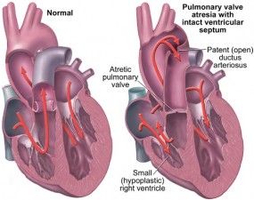 Caleb's actual diagnosis and a visual of his heart. Chd Babies, Pregnancy Exercises, Chd Awareness, Congenital Heart Defect, Heart Defect, Congenital Heart, Nursing Programs, Cardiology, Core Strength