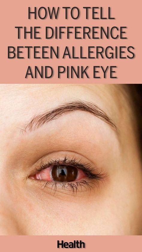 How to Tell the Difference Between Allergies and Pink Eye Eye Irritation Remedies, Itchy Eyes Remedy, Goopy Eyes, Treating Pink Eye, Eye Allergy Relief, Pinkeye Remedies, Allergy Eyes, Natural Remedies For Migraines, Swollen Eyes