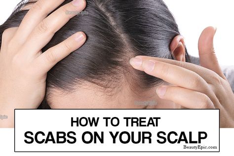 How to Get Rid of Scabs on Scalp - What it is, Causes and How to Treat Shingles On Face, Scabs On Scalp, Scalp Scabs, Sores On Scalp, Dry Scaly Skin, Vinegar For Hair, Hair Tea, Coconut Oil Hair Mask, Homemade Shampoo