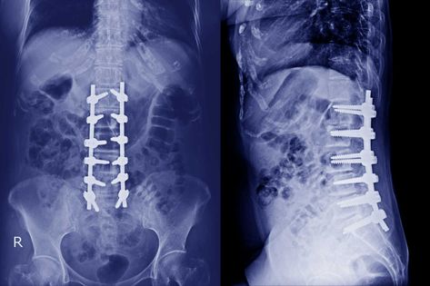 Dish Spine Disease, Degenerate Disc Disease, Degenerative Lumbar Disc Disease, Spinal Degeneration, Lumbar Disc, Intervertebral Disc, Degenerative Disease, Head Pain, Spine Health