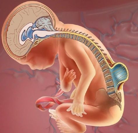 Spina bifida is a birth defect affecting the spinal column. Spina bifida progresses from a cleft, or splitlike opening, in the back part of the backbones (the spinal vertebrae). In more severe cases, it involves the spinal cord. Spina bifida is the most common of a group of birth defects known as neural tube defects, which affect the central nervous system. It can impair your toddler’s brain, spine, spinal cord, and meninges (tissues covering and protecting the brain and the spinal cord). Spina Bifida Awareness, Spinal Fluid, Spinal Column, Spinal Nerve, Spina Bifida, Social Stigma, Womens Health Care, Poor Nutrition, High Fever