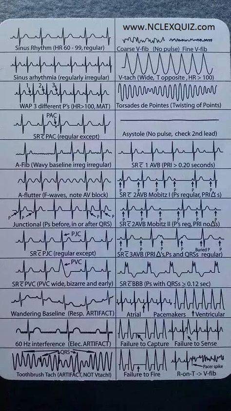 Ekg Rhythms, Paramedic School, Nursing Cheat, Nursing Student Tips, Medical Student Study, Cardiac Nursing, Nursing School Survival, Critical Care Nursing, Nursing School Studying